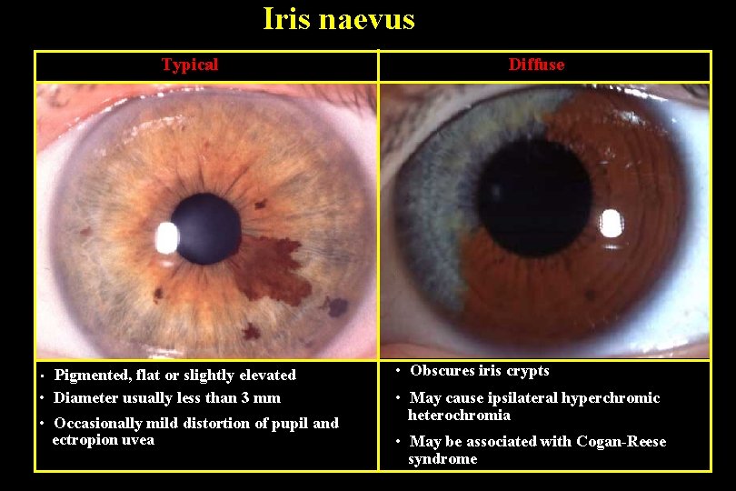 Iris naevus Typical Pigmented, flat or slightly elevated • Diameter usually less than 3
