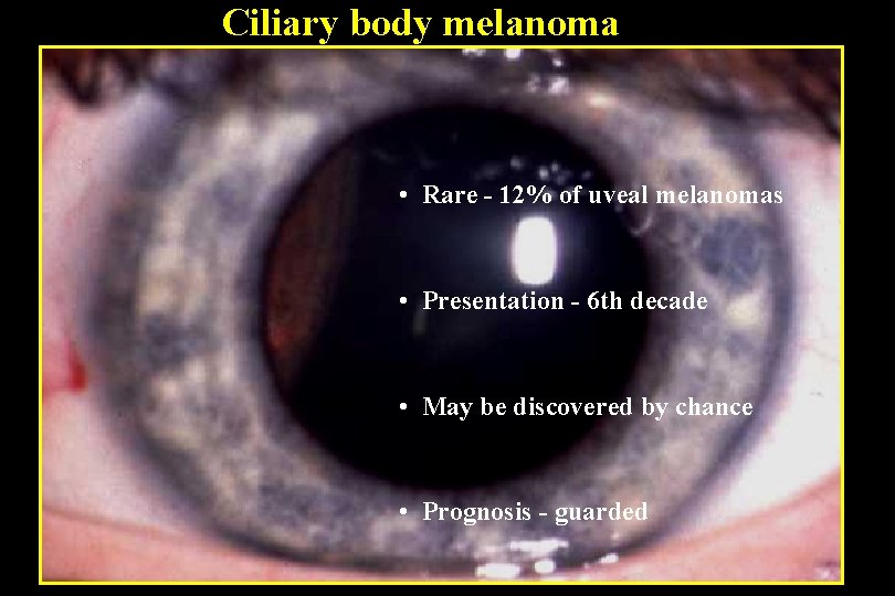 Ciliary body melanoma • Rare - 12% of uveal melanomas • Presentation - 6