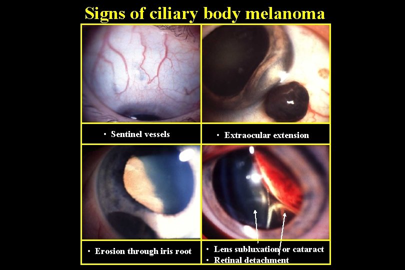 Signs of ciliary body melanoma • Sentinel vessels • Extraocular extension • Erosion through