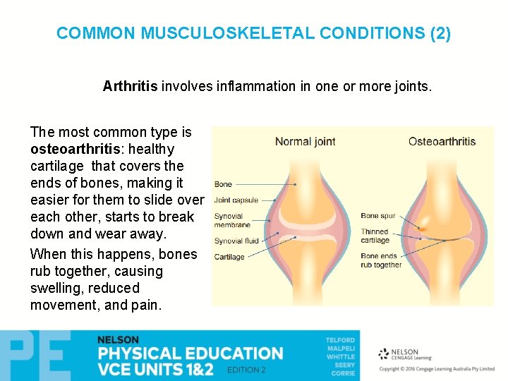 COMMON MUSCULOSKELETAL CONDITIONS (2) Arthritis involves inflammation in one or more joints. The most