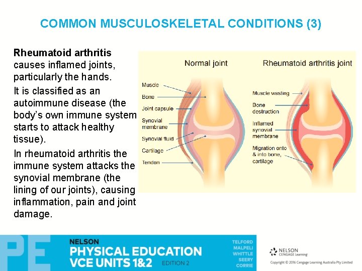 COMMON MUSCULOSKELETAL CONDITIONS (3) Rheumatoid arthritis causes inflamed joints, particularly the hands. It is