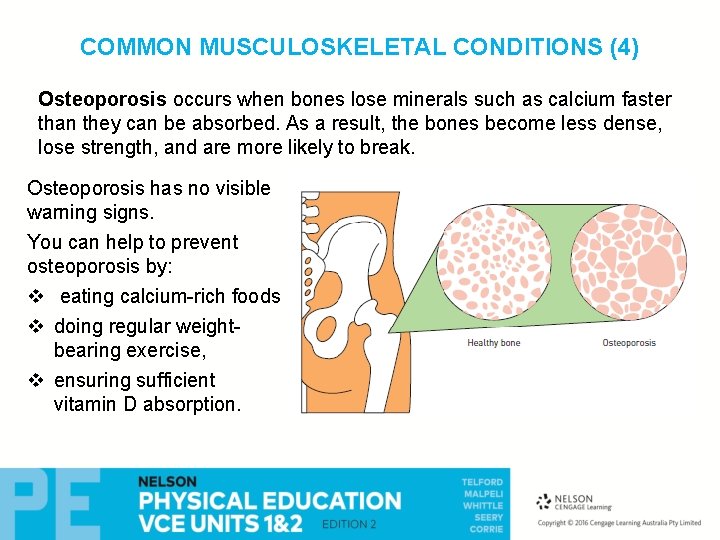 COMMON MUSCULOSKELETAL CONDITIONS (4) Osteoporosis occurs when bones lose minerals such as calcium faster