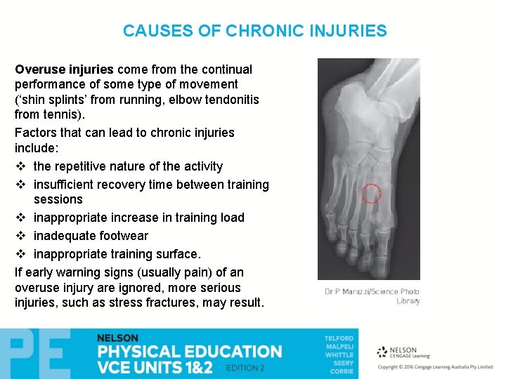 CAUSES OF CHRONIC INJURIES Overuse injuries come from the continual performance of some type