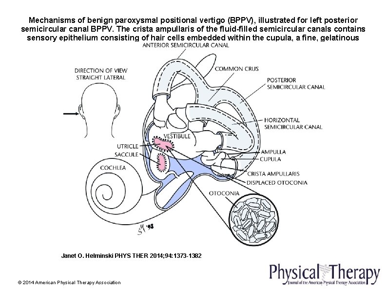 Mechanisms of benign paroxysmal positional vertigo (BPPV), illustrated for left posterior semicircular canal BPPV.