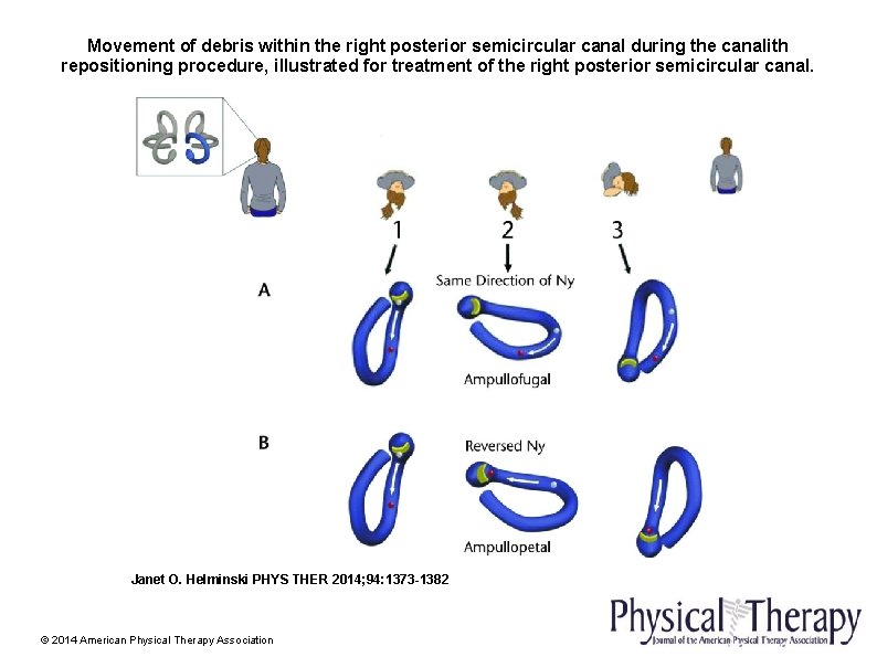 Movement of debris within the right posterior semicircular canal during the canalith repositioning procedure,