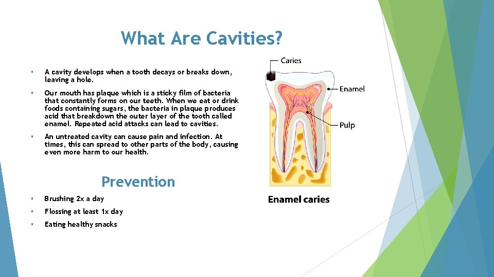 What Are Cavities? § A cavity develops when a tooth decays or breaks down,