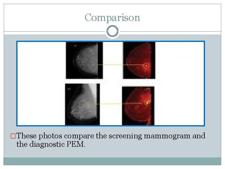 Comparison �These photos compare the screening mammogram and the diagnostic PEM. 