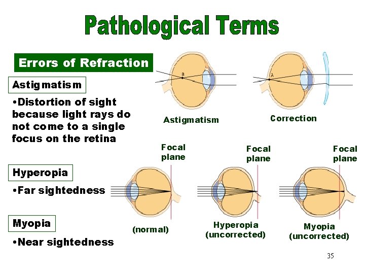 Errors of Refraction Astigmatism • Distortion of sight because light rays do not come