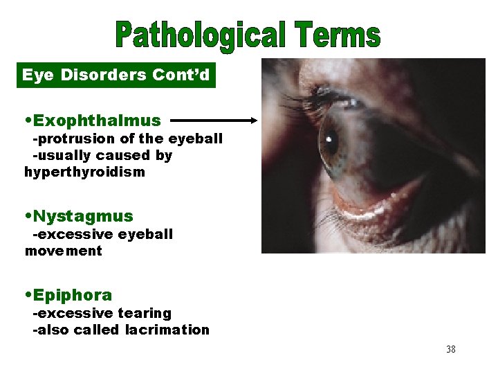 Exophthalmus Eye Disorders Cont’d • Exophthalmus -protrusion of the eyeball -usually caused by hyperthyroidism