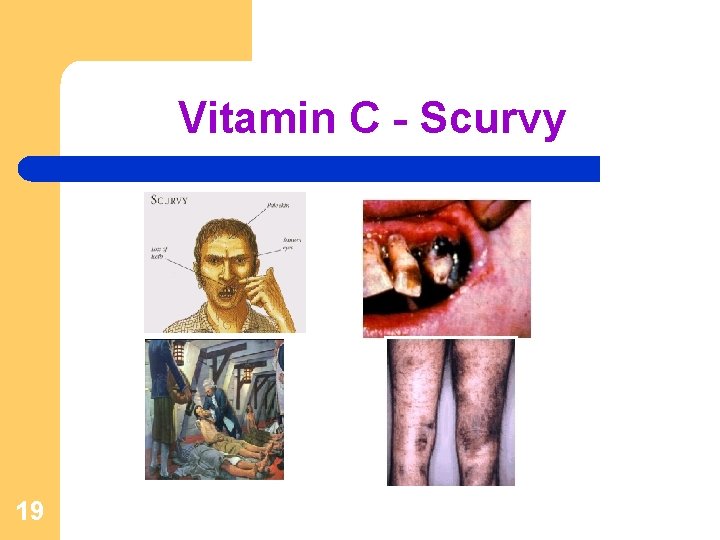 Vitamin C - Scurvy 19 