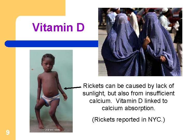 Vitamin D Rickets can be caused by lack of sunlight, but also from insufficient