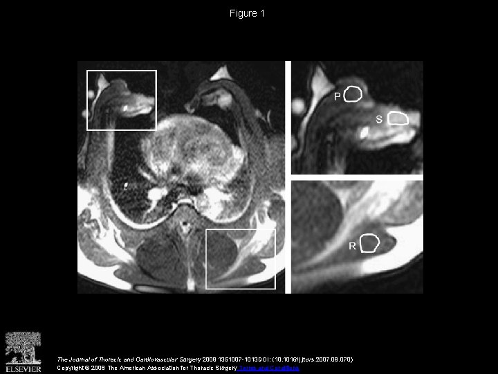 Figure 1 The Journal of Thoracic and Cardiovascular Surgery 2008 1351007 -1013 DOI: (10.