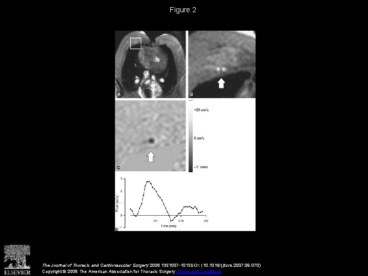 Figure 2 The Journal of Thoracic and Cardiovascular Surgery 2008 1351007 -1013 DOI: (10.