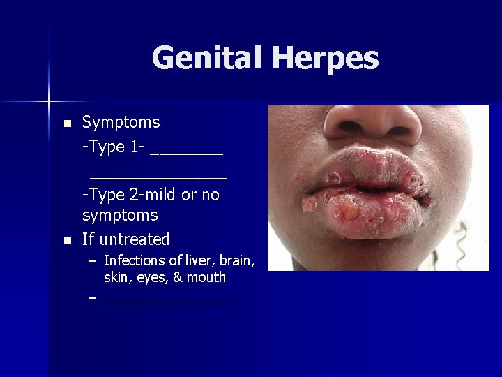 Genital Herpes n n Symptoms -Type 1 - _______________ -Type 2 -mild or no