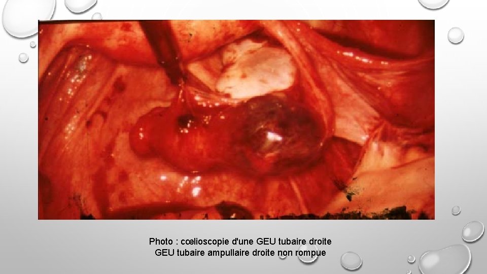 Photo : cœlioscopie d'une GEU tubaire droite GEU tubaire ampullaire droite non rompue 