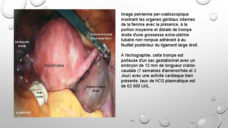 Image pelvienne per-cœlioscopique montrant les organes génitaux internes de la femme avec la présence,