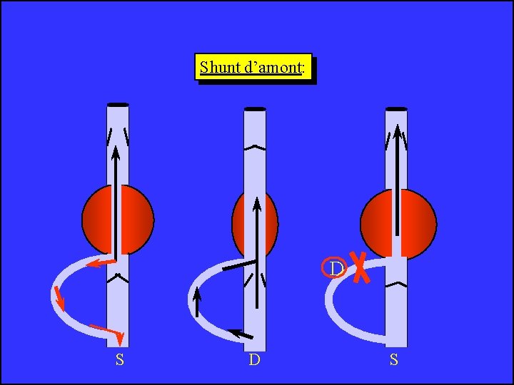 Shunt d’amont: D S 