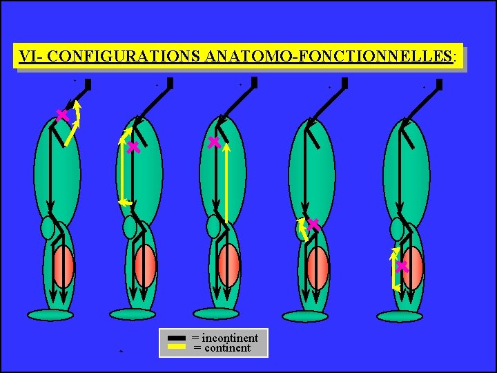 VI- CONFIGURATIONS ANATOMO-FONCTIONNELLES: = incontinent = continent 