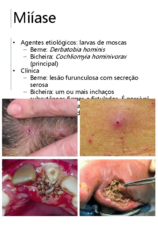 Miíase • Agentes etiológicos: larvas de moscas – Berne: Derbatobia hominis – Bicheira: Cochliomyia