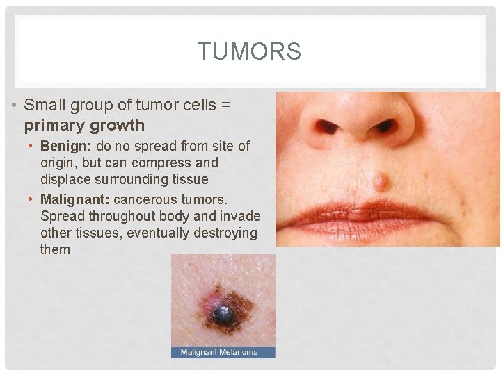 TUMORS • Small group of tumor cells = primary growth • Benign: do no