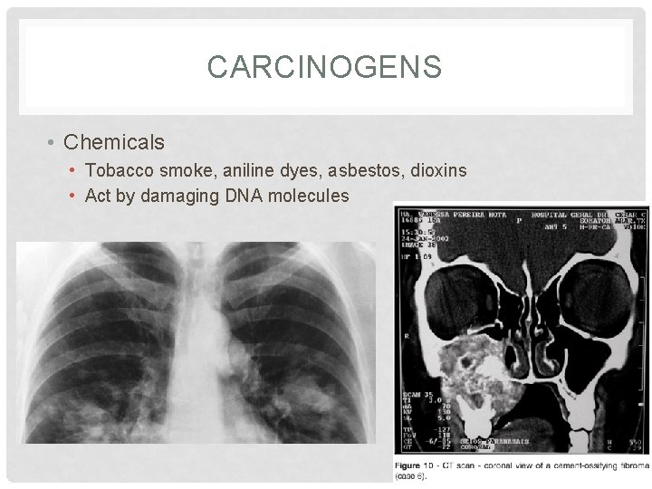 CARCINOGENS • Chemicals • Tobacco smoke, aniline dyes, asbestos, dioxins • Act by damaging