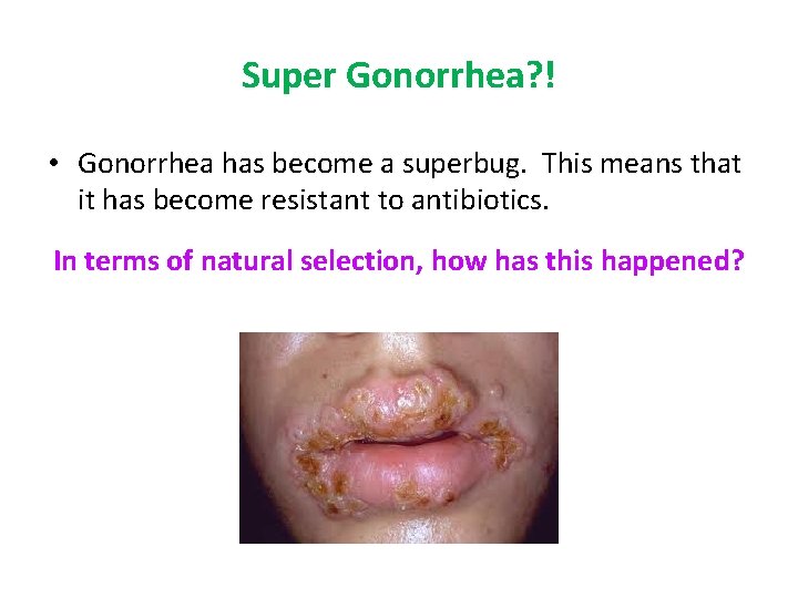 Super Gonorrhea? ! • Gonorrhea has become a superbug. This means that it has
