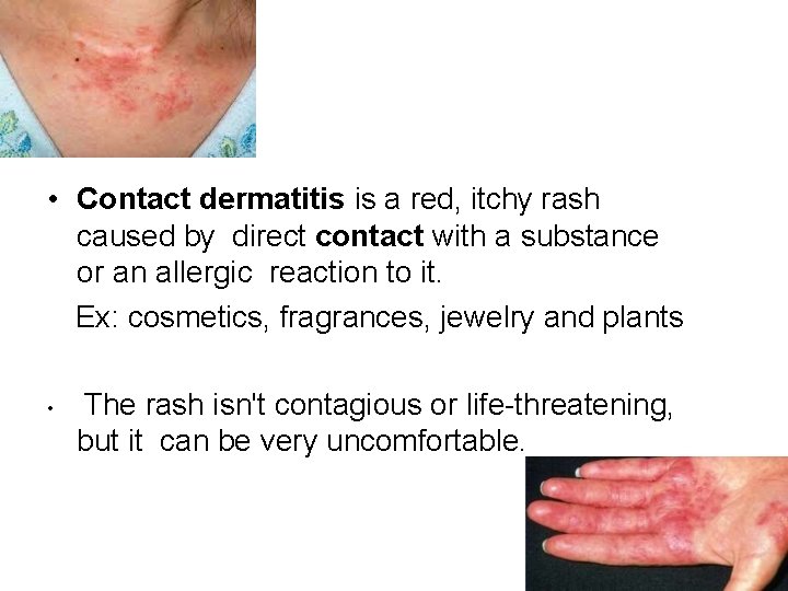  • Contact dermatitis is a red, itchy rash caused by direct contact with