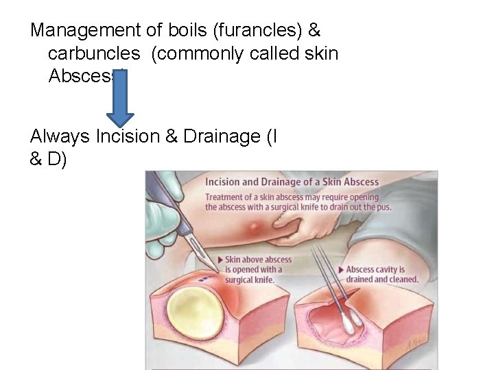 Management of boils (furancles) & carbuncles (commonly called skin Abscess) Always Incision & Drainage