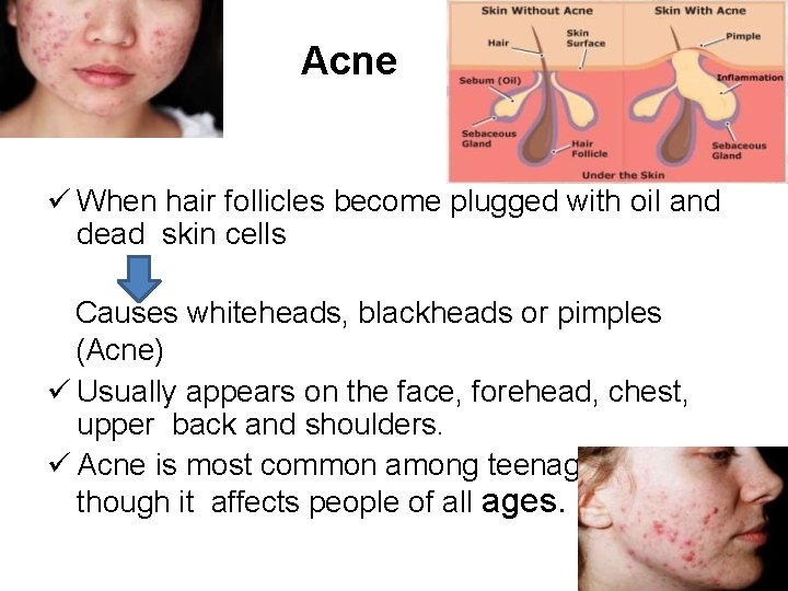 Acne When hair follicles become plugged with oil and dead skin cells Causes whiteheads,