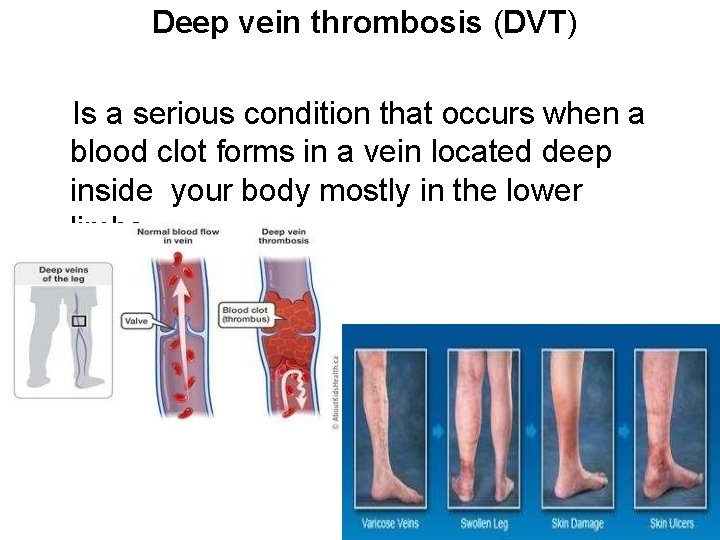 Deep vein thrombosis (DVT) Is a serious condition that occurs when a blood clot