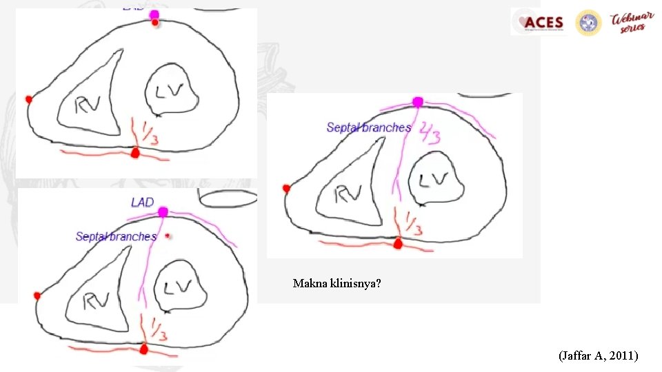 Makna klinisnya? (Jaffar A, 2011) 