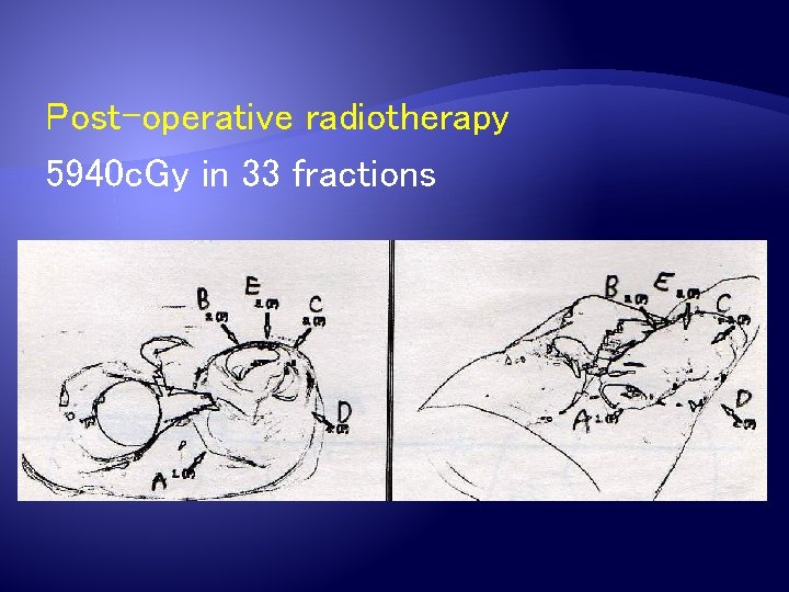 Post-operative radiotherapy 5940 c. Gy in 33 fractions 