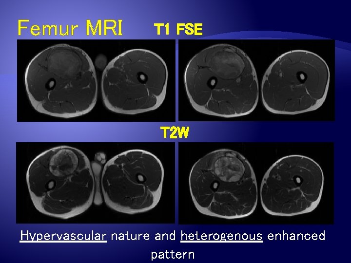 Femur MRI T 1 FSE T 2 W Hypervascular nature and heterogenous enhanced pattern