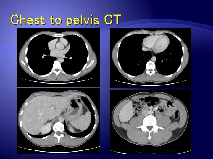 Chest to pelvis CT 