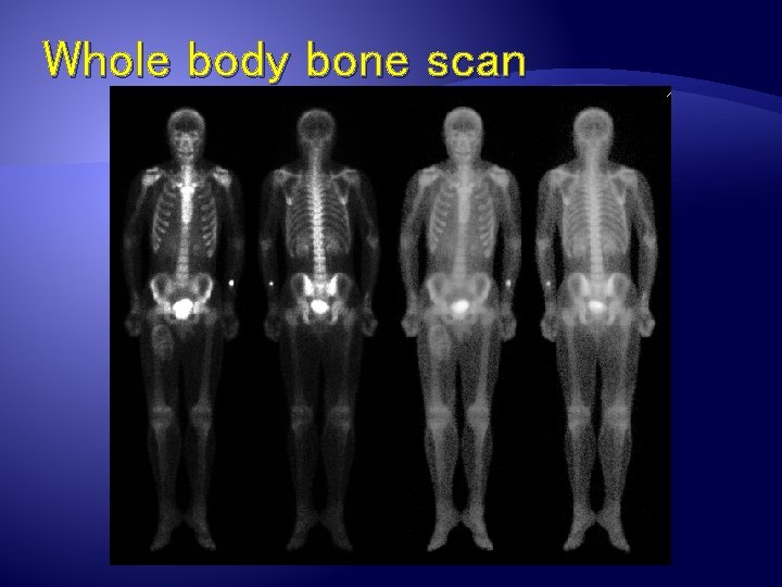 Whole body bone scan 