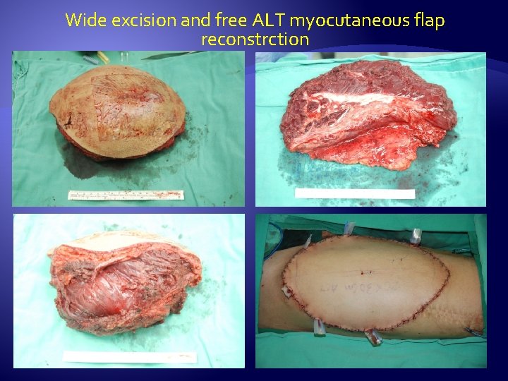 Wide excision and free ALT myocutaneous flap reconstrction 