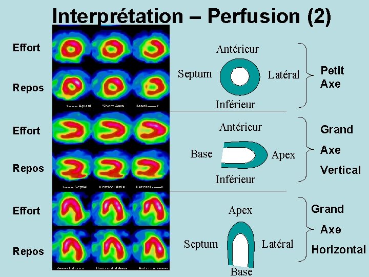 Interprétation – Perfusion (2) Effort Antérieur Septum Latéral Repos Petit Axe Inférieur Antérieur Effort