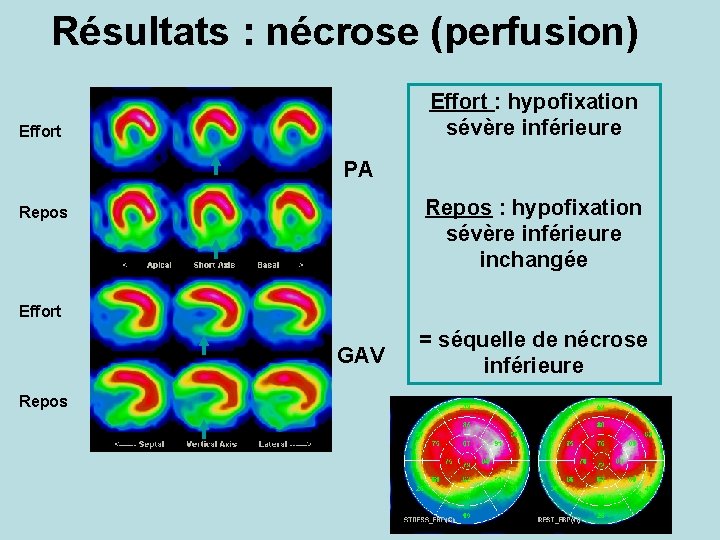 Résultats : nécrose (perfusion) Effort : hypofixation sévère inférieure Effort PA Repos : hypofixation