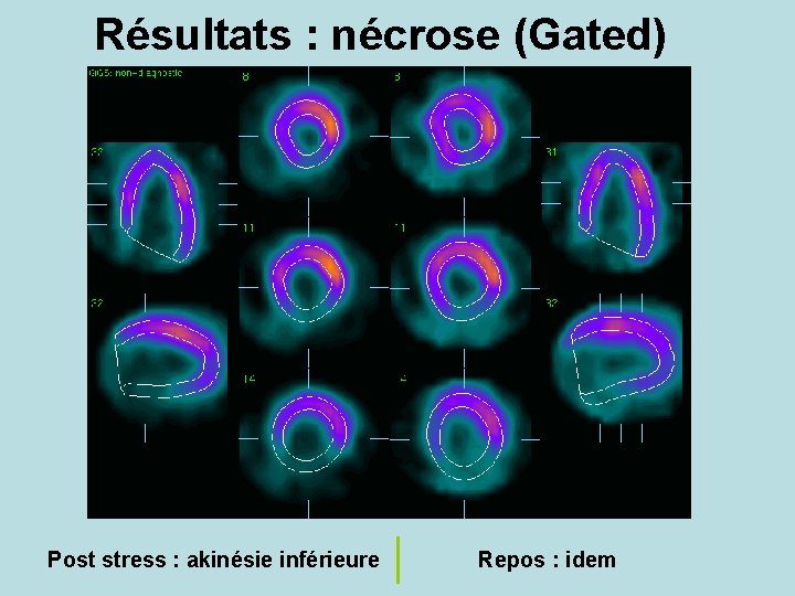 Résultats : nécrose (Gated) Post stress : akinésie inférieure Repos : idem 