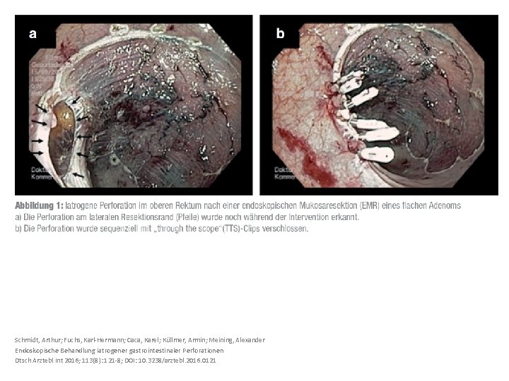 Schmidt, Arthur; Fuchs, Karl-Hermann; Caca, Karel; Küllmer, Armin; Meining, Alexander Endoskopische Behandlung iatrogener gastrointestinaler