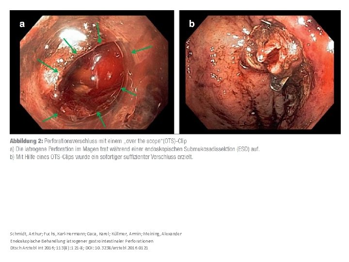 Schmidt, Arthur; Fuchs, Karl-Hermann; Caca, Karel; Küllmer, Armin; Meining, Alexander Endoskopische Behandlung iatrogener gastrointestinaler