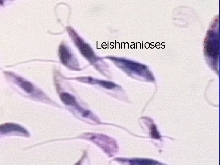 Leishmanioses 