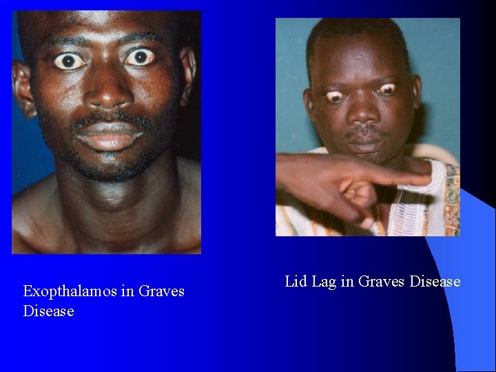 Exopthalamos in Graves Disease Lid Lag in Graves Disease 