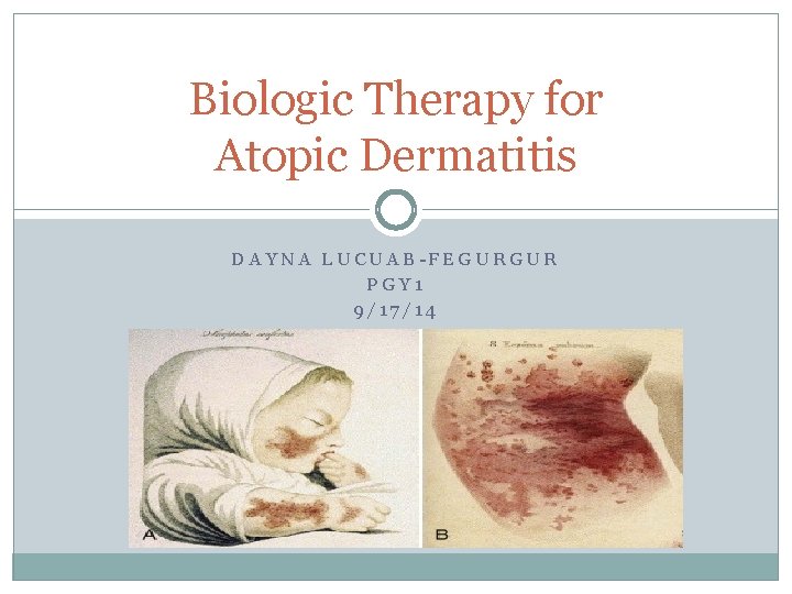 Biologic Therapy for Atopic Dermatitis DAYNA LUCUAB-FEGURGUR PGY 1 9/17/14 