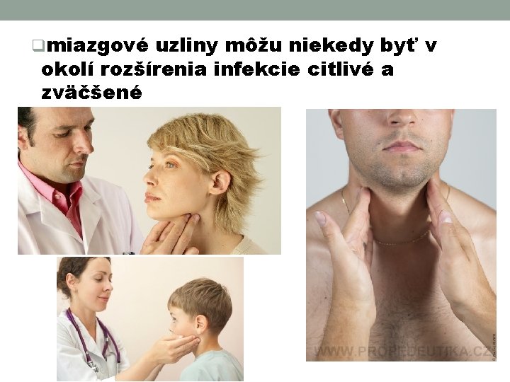 qmiazgové uzliny môžu niekedy byť v okolí rozšírenia infekcie citlivé a zväčšené 