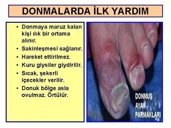 DONMALARDA İLK YARDIM • Donmaya maruz kalan kişi ılık bir ortama alınır. • Sakinleşmesi