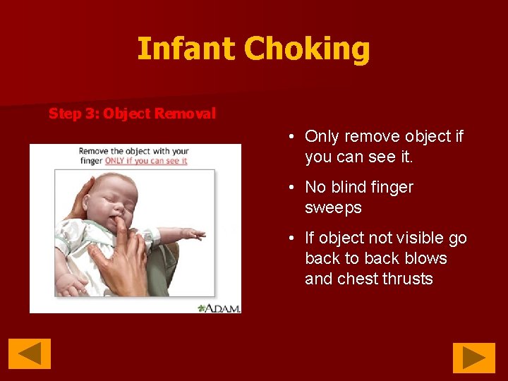 Infant Choking Step 3: Object Removal • Only remove object if you can see