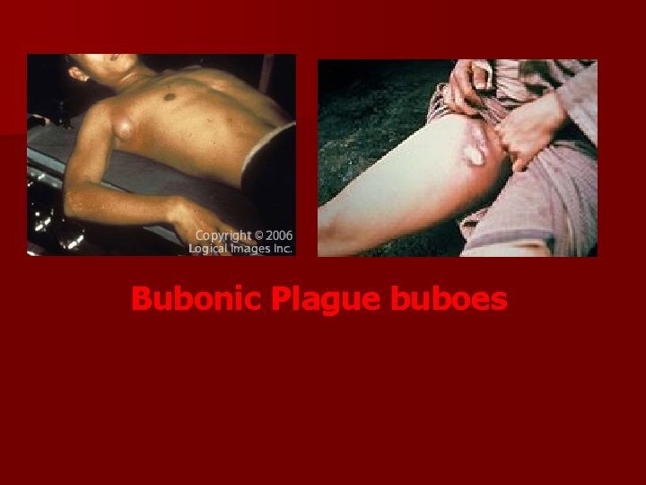 Bubonic Plague buboes Bubonic Plague buboes