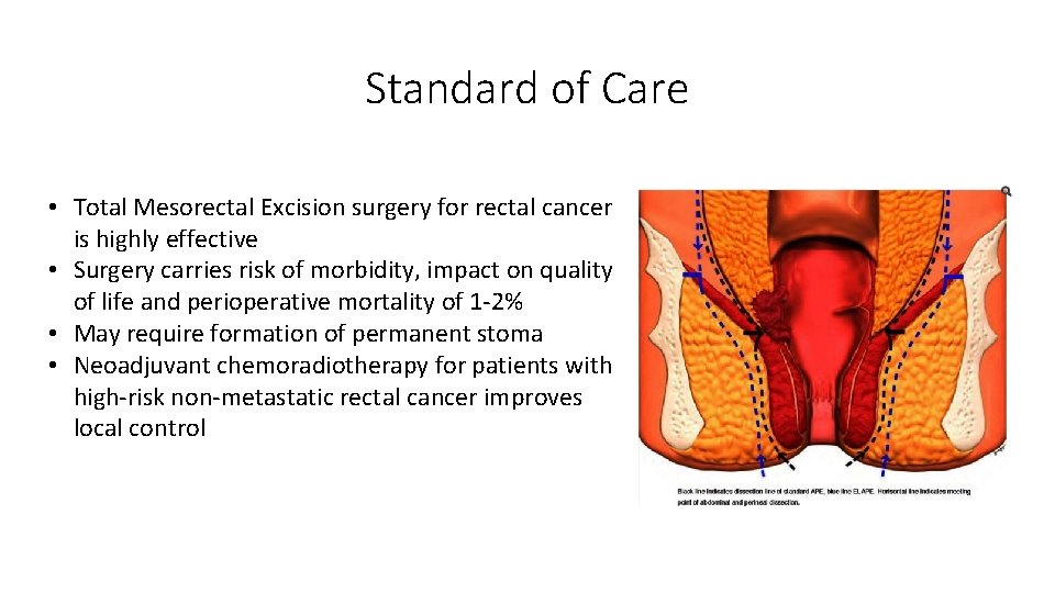 Standard of Care • Total Mesorectal Excision surgery for rectal cancer is highly effective