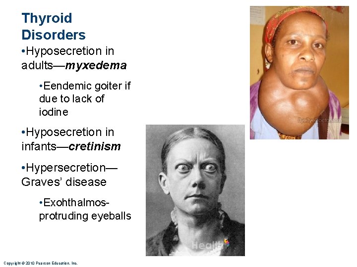 Thyroid Disorders • Hyposecretion in adults—myxedema • Eendemic goiter if due to lack of